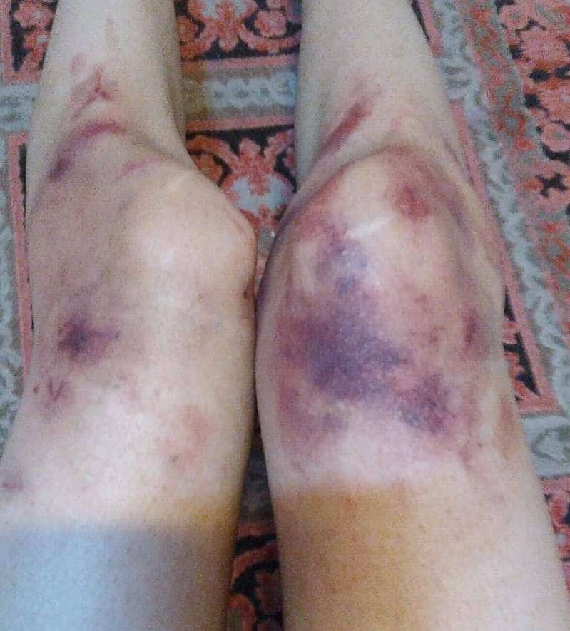 The knees of a teenage girl, 17, after she was pulled on the ground by vice patrols.